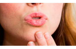 Обгоревшие губы: симптомы, лечение, средства защиты и профилактика