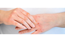 Выявление распространенных бактериальных инфекций кожи